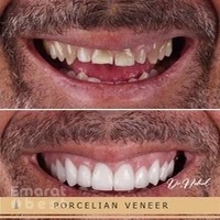Veneers Dubai - Hollywood Smile