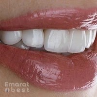Veneers Dubai - Hollywood Smile