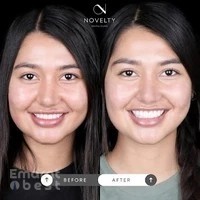 Hollywood smile - Veneers in Dubai