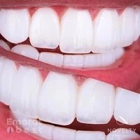 Hollywood smile - Veneers in Dubai