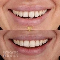 Dr. Firas | Composite Bonding - Dubai