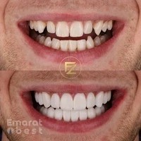 Dr. Firas | Composite Bonding - Dubai