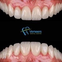 Veneers Dental Centre