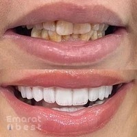 Veneers Dental Centre