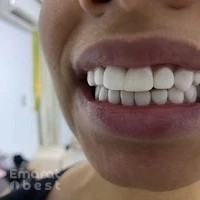 16TEETH