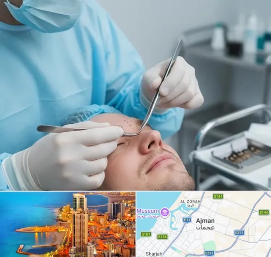 Beard Transplant in Ajman