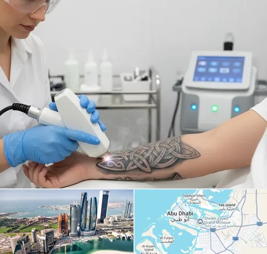 Tattoo Removal in Abu Dhabi