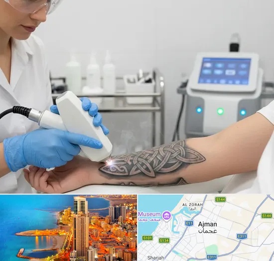 Tattoo Removal in Ajman