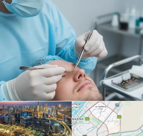 Beard Transplant in Al Barsha