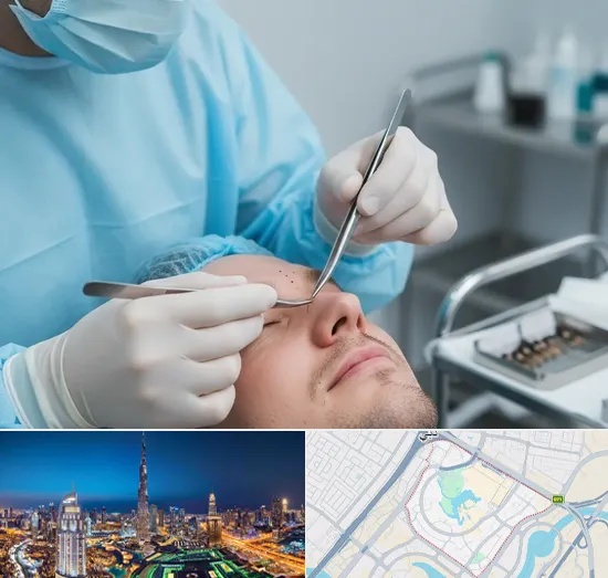 Beard Transplant in Downtown Dubai