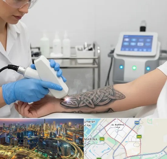 Tattoo Removal in Al Barsha