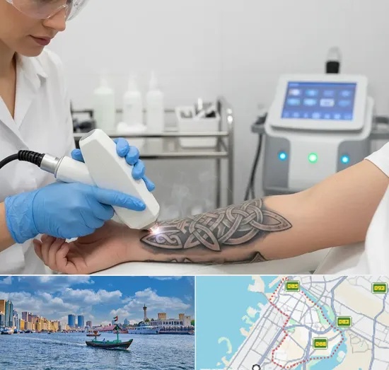 Tattoo Removal in Bur Dubai