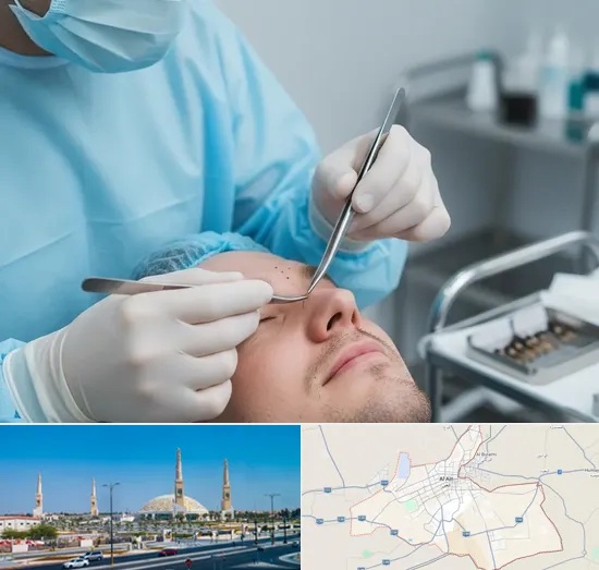 Beard Transplant in Al Ain