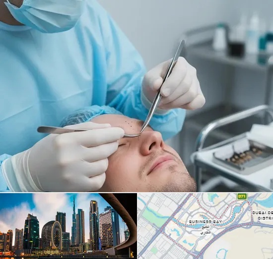 Beard Transplant in Business Bay