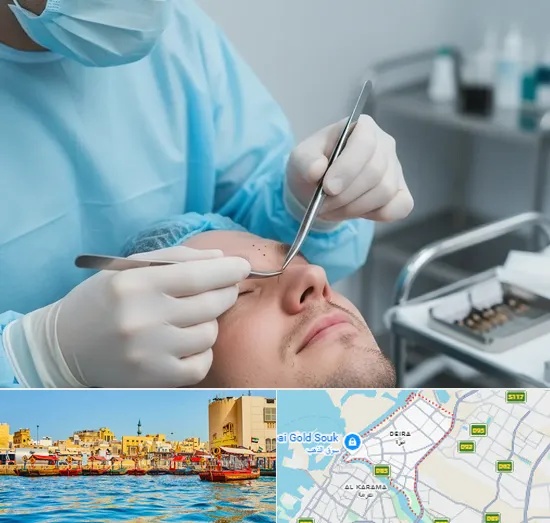Beard Transplant in Deira