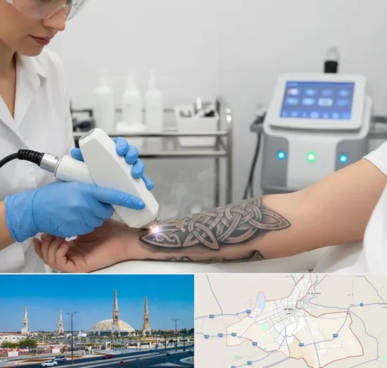 Tattoo Removal in Al Ain