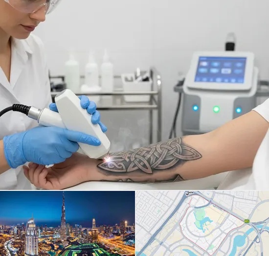 Tattoo Removal in Downtown Dubai