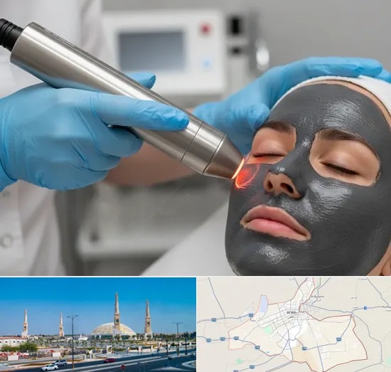 Carbon Laser Peel in Al Ain