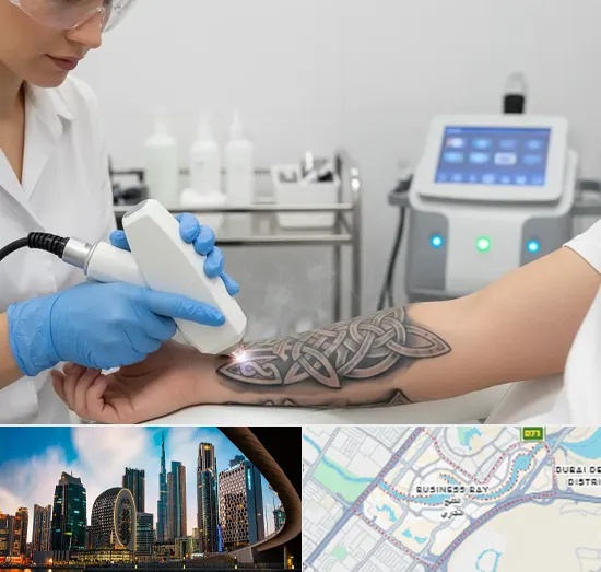 Tattoo Removal in Business Bay