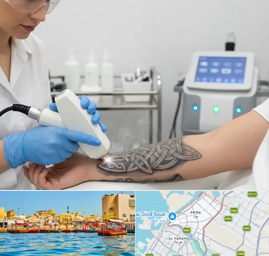 Tattoo Removal in Deira